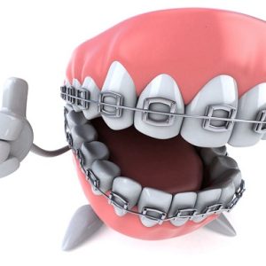 Aparat dentar metalic