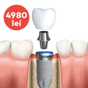Pachet implant dentar Nobel Parallel
