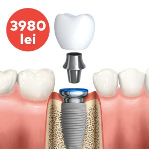 Pachet implant dentar