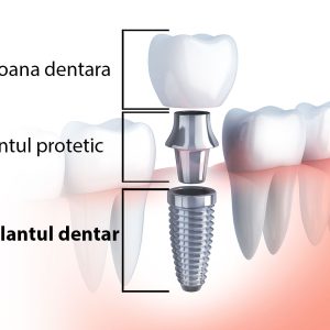 Implant Dentar