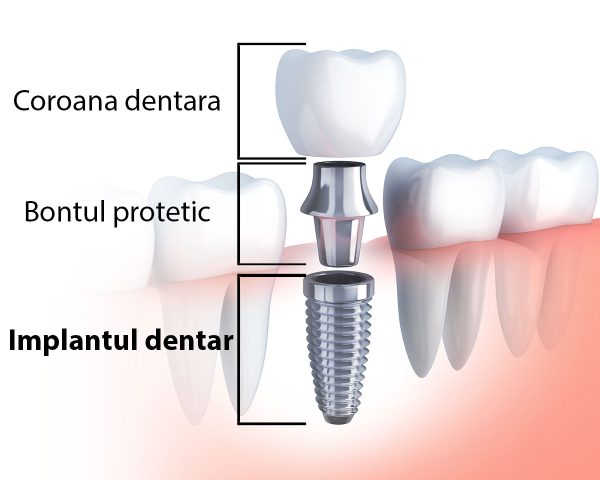 Implant Dentar